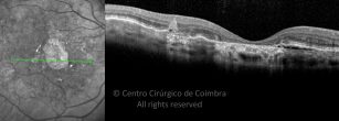 A OCT mostra uma membrana neovascular coroidea e a estrutura retiniana deformada. Note a acumulação de fluído subretiniano e sangue/lípidos sub-EPR