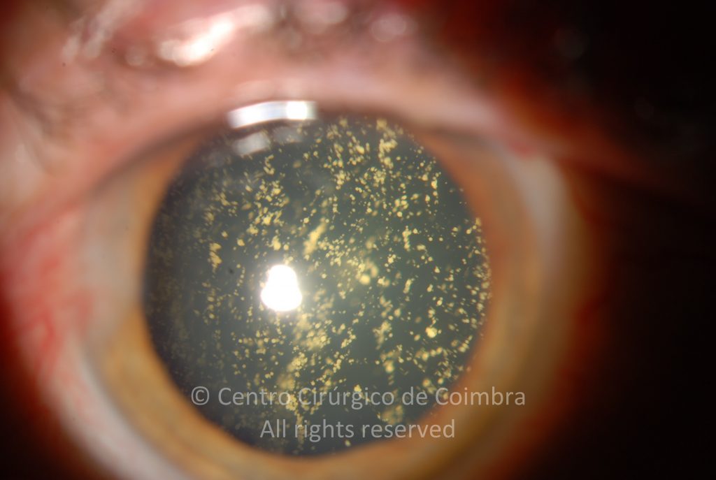 HYALOPATHIE AST RO DE Atlas RL Eye