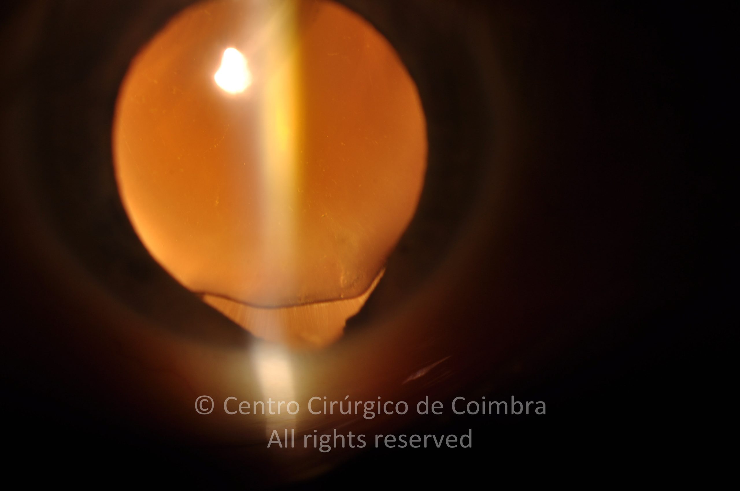 Colobome Chorïorétinien - Atlas RL Eye