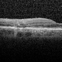 Lymphome rétinien et du SNC Lymphome rétinien et du SNC