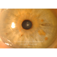 Catarata subcapsular posterior
