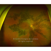 Atrofia Coriorretiniana Pigmentada Paravenosa Atrofia Coriorretiniana Pigmentada Paravenosa