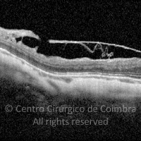 Membrana Epirretiniana; Tracção vítreomacular