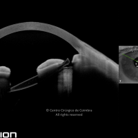 Traumatismo da íris pela lente intraocular