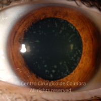 Catarata congénita azul (catarata cerúlea)