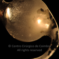 Lente intraocular com depósitos de CaCO3