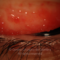Conjuntivite Papilar Gigante