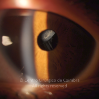 Subluxação do cristalino; Síndrome de Marfan