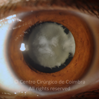 Catarata congénita