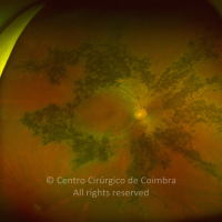 Atrofia Coriorretiniana Pigmentada Paravenosa