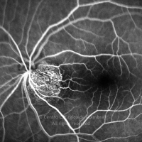 Hemangioma do nervo óptico (angiografia fluoresceínica)