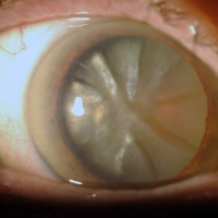 Catarata cortical madura