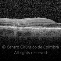 Linfoma da Retina e do SNC