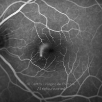 Coriorretinopatia Serosa Central; derrame típico na angiografia fluoresceínica.