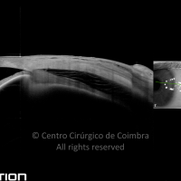 Descolamento do Corpo Ciliar
