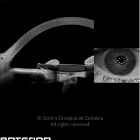 Lente Intraocular a traumatizar a íris