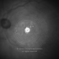 Infravermelho; lente intraocular multifocal num doente com queratotomia radial; membrana epirretiniana