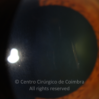 Traumatismo com forceps