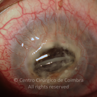 "Melting" da córnea com exposição da lente intraocular.