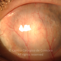 Após cirurgia (tamponamento do buraco corneano com retalho escleral e recobrimento conjuntival) para evitar a enucleação.