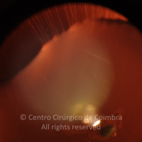 Coloboma do Cristalino; Catarata Subcapsular Posterior