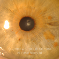 Catarata subcapsular posterior