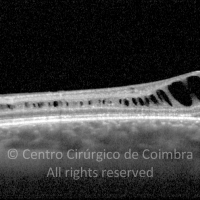 Retinosquisis ligada ao X