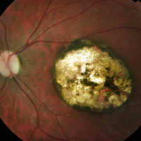Toxoplasmose Ocular