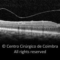 Membrana Hialoide