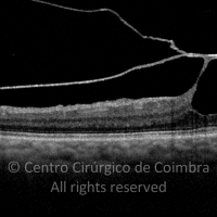 Síndroma de Tração Vitreorretiniana