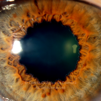 Ocular Manifestation of Paramyloidosis