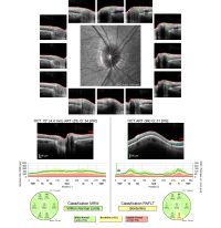 11-2152181-20211216-002-RNFL