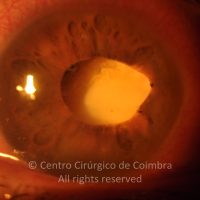 Reposição do cristalino após subluxação (catarata total). Reposição do cristalino após subluxação (catarata total).