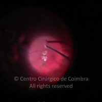 Cirurgia de remoção de fragmentos de cristalino no vítreo Cirurgia de remoção de fragmentos de cristalino no vítreo