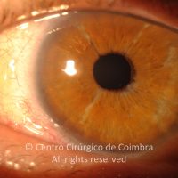 Marcas de retractores na íris Marcas de retractores na íris
