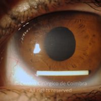 Migração do implante de Dexametasona para a câmara anterior Migração do implante de Dexametasona para a câmara anterior