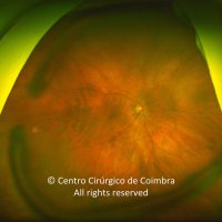 Shadow on the retina from the Ferrara Rings for keratoconus