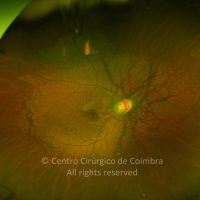 Estrias Angioides Estrias Angioides