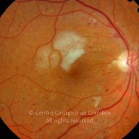 Manchas Algodonosas; Retinopatia Diabética Manchas Algodonosas; Retinopatia Diabética