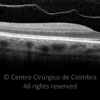 Vitreous Detachment