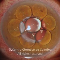 Bolhas de silicone na câmara anterior
