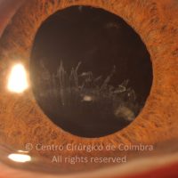 Sub-luxação da LIO e saco capsular Sub-luxação da LIO e saco capsular