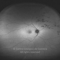 "Bear Tracks"- Hipertrofia Congénita do Epitélio Pigmentado da Retina "Bear Tracks"- Hipertrofia Congénita do Epitélio Pigmentado da Retina