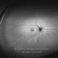 Optomap (autofluorescência) sem alterações Optomap (autofluorescência) sem alterações