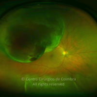 Choroidal Melanoma