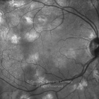 Multiple Evanescent White Dots Syndrome, IR