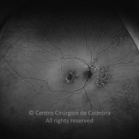 Cone-Rod Dystrophy