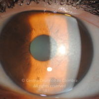 Tangier disease (hypoalphalipoproteinemia) - corneal opacities