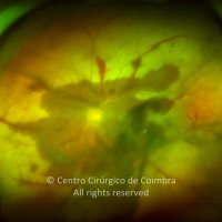 Progressive Outer Retinal Necrosis