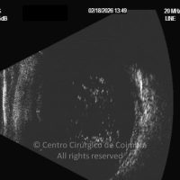 Hialose Asteróide Hialose Asteróide